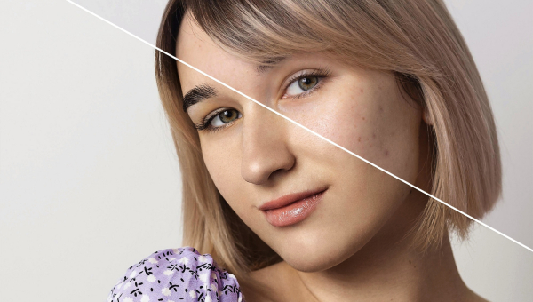 Do czego używa się botoxu? Jak działa botox.